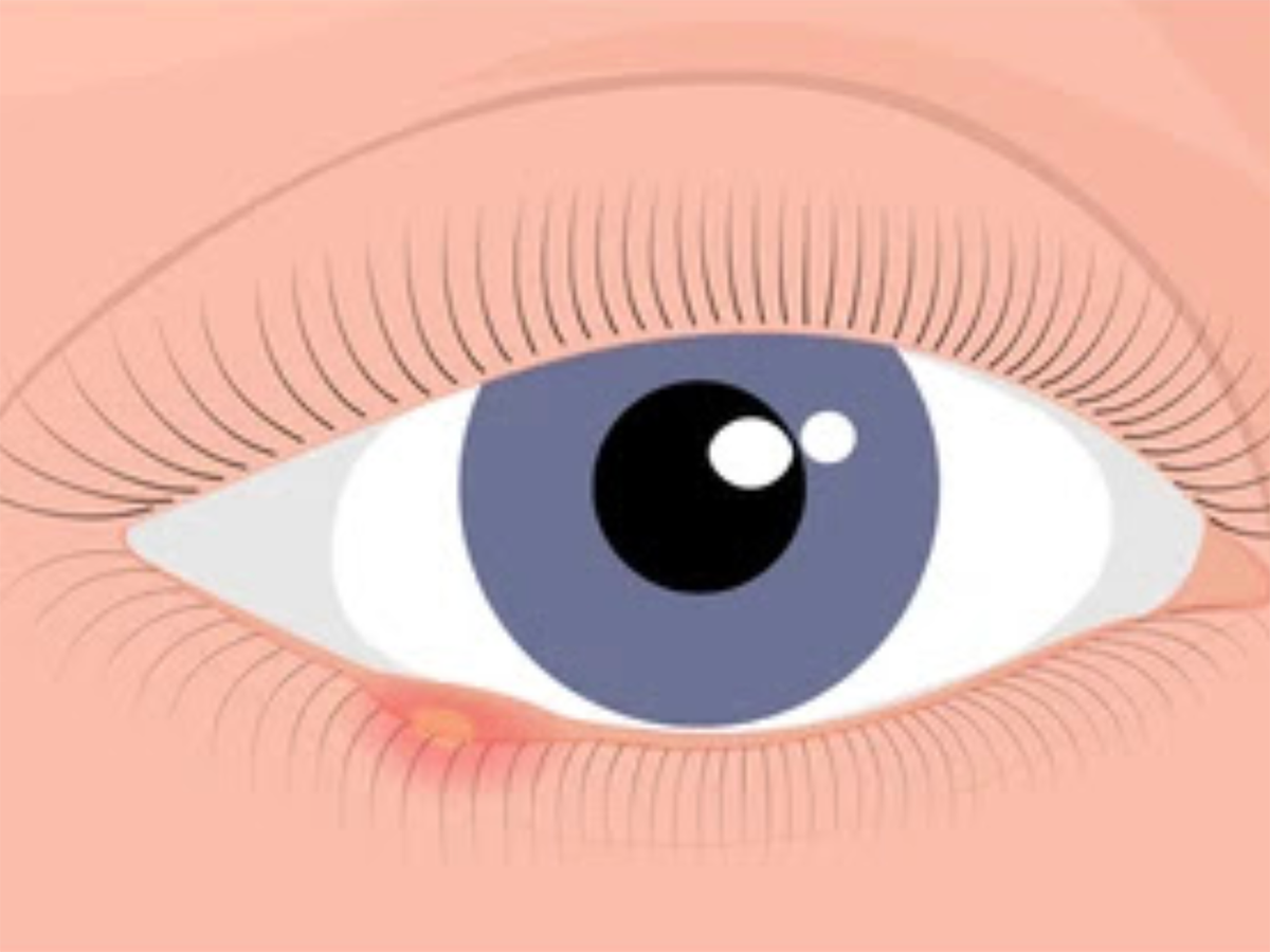 A stye on the bottom of an eye