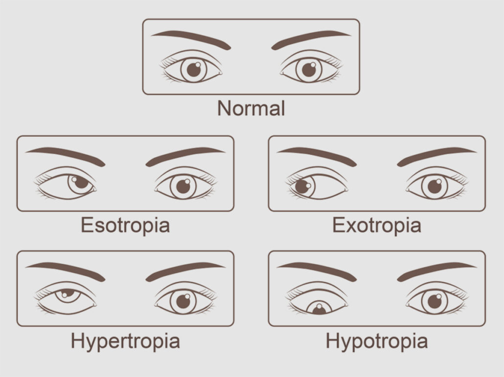 Different types of strabismus